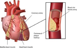 best ayurvedic treatment for heart care