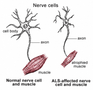 motor neuron disease