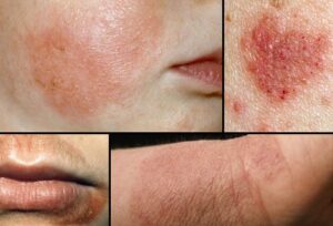 eczema and its ayurvedic treatment
