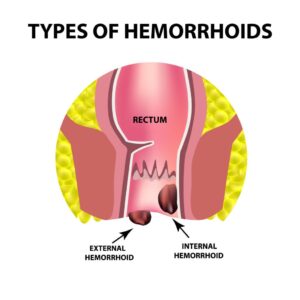 hemorrhoids types 