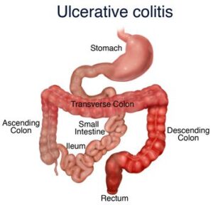 natural way to prevent ulcerative colitis