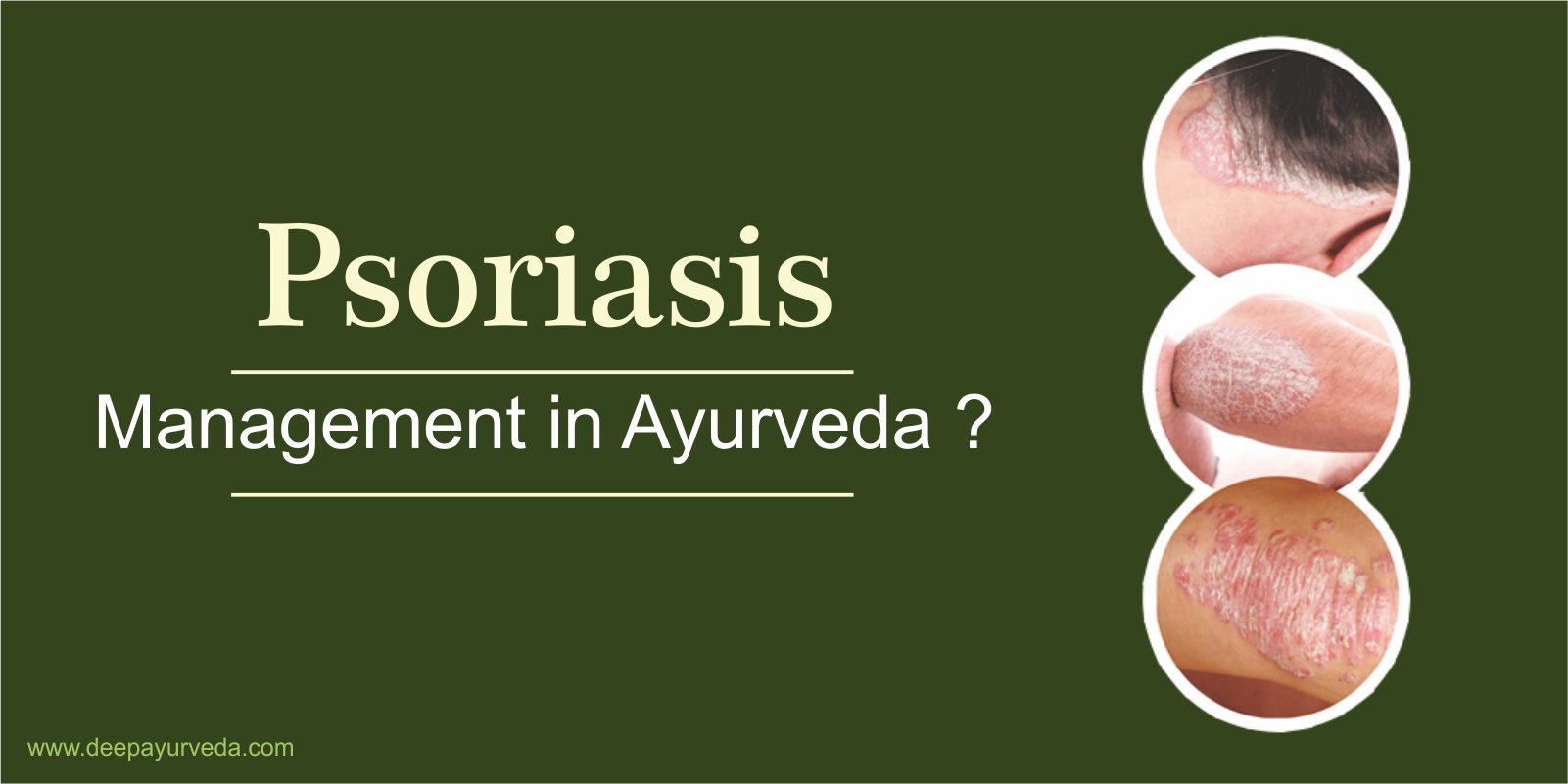 Psoriasis Treatment in Ayurveda Medicine & Its Management in Ayurveda