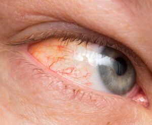 Eye Disease
