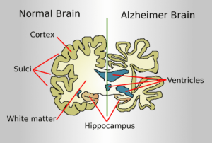 causes of alzheimer's disease