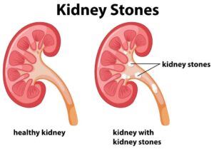 kidney stone 