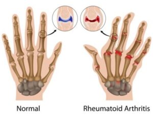 Rheumatoid Arthritis Ayurvedic Treatment