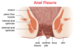 Anal Fissure Ayurvedic Treatment