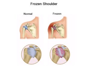 frozen shoulder ayurvedic treatment package