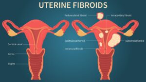 uterine fibroid types