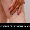 Varicose Vein Ayurvedic Treatment