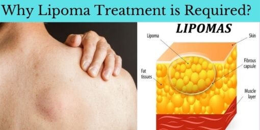 lipoma ayurvedic treatment pack