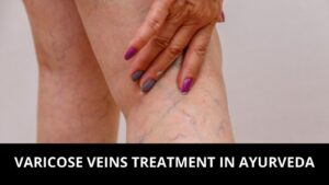 Ayurvedic Treatment of Varicose Vein