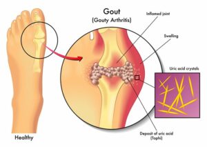 Symptoms of gout