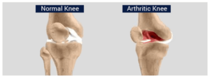 knee disorder
