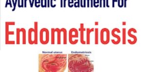 Ayurvedic treatment of Endometriosis
